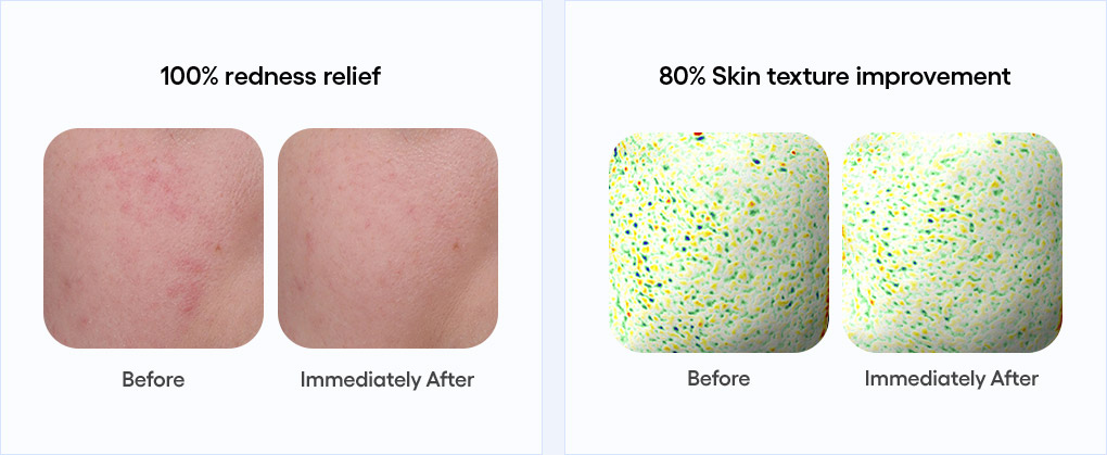 100% redness relief : Before/Immediately After , 80% Skin texture improvement : Before/Immediately After